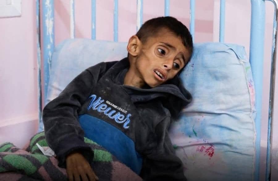 برنامهی جهانی غذا، هشدار داده که بیش از ۷۰ هزار کودک فلسطینی با سوءتغذیهی شدید مواجه اند.